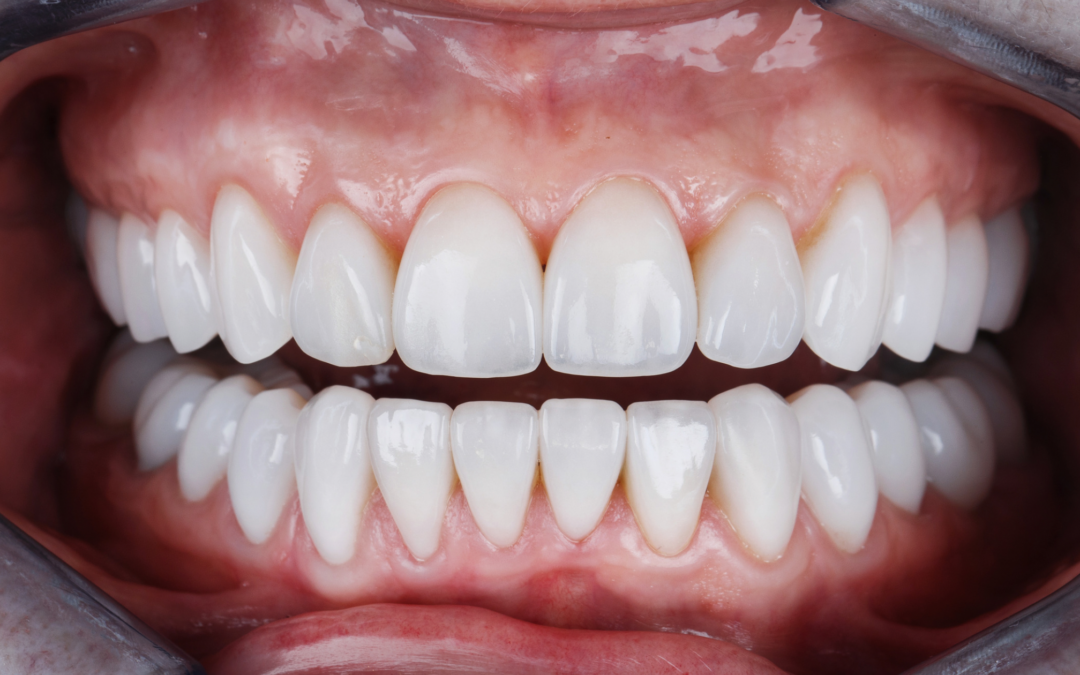 Carillas Dentales: Mucho Más que Estética