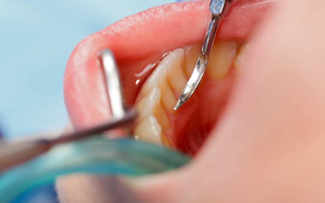 La Importancia de Comenzar con una Revisión y Limpieza Dental Regular