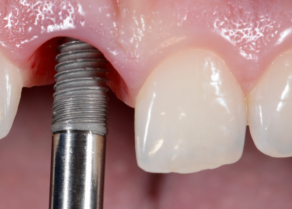 Esta Navidad, Regala Sonrisas: Todo lo que Necesitas Saber Sobre los Implantes Dentales