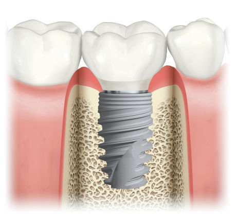 ¿Los implantes dentales: la mejor opción para un diente perdido?