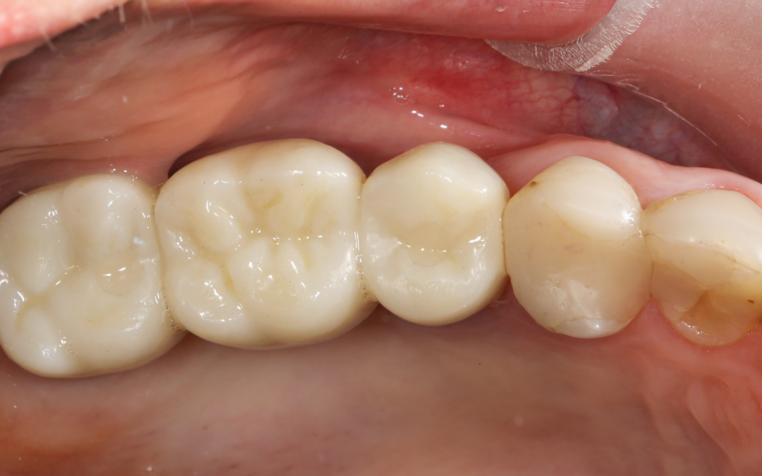 Implantes vs. Puentes Dentales: Entendiendo las Diferencias y la Importancia de Actuar a Tiempo
